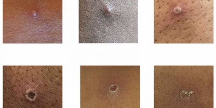 Detectado en Málaga un posible primer de viruela del mono en Andalucía 1 Detectado en Málaga un posible primer de viruela del mono en Andalucía